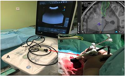 Application of Intraoperative Ultrasound Navigation in Neurosurgery